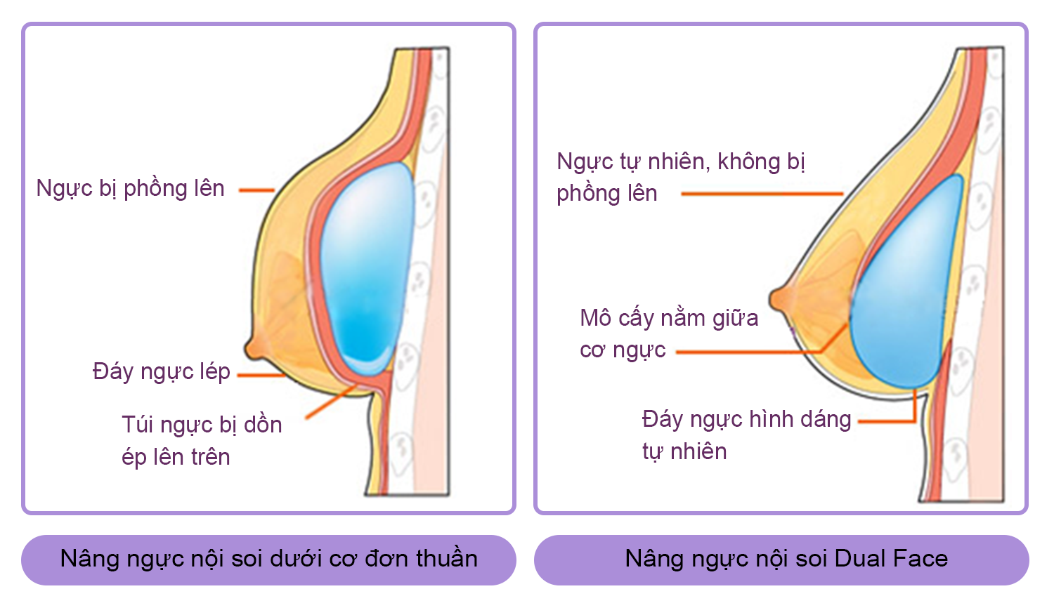 Khác biệt nâng ngực nội soi thường và nội soi Dual Face
