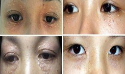 Cách chữa và điều trị mụn thịt quanh mắt