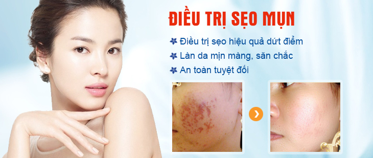Điều trị sẹo mụn hiệu quả Điều trị sẹo mụn hiệu quả