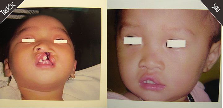 Bác sĩ Nguyễn Chí Thanh phẫu thuật nhân đạo cho trẻ em dị tật bẩm sinh