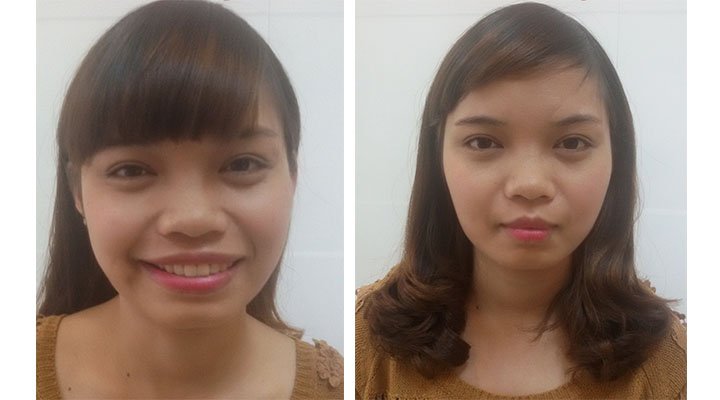 Khách hàng phẫu thuật thu gọn miệng