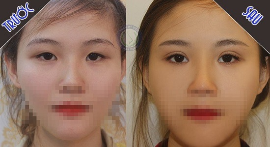 Phương Thảo trước và sau bấm mắt 2 mí Hàn Quốc tại Hà Thanh