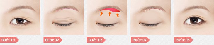 Hiểu hơn về công nghệ cắt mí Hàn Quốc