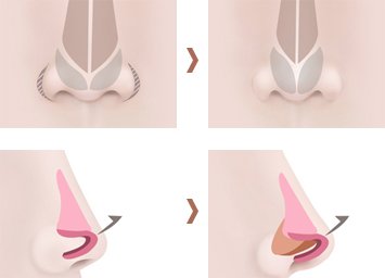 Thu gọn cánh mũi là gì Thu gọn cánh mũi là gì
