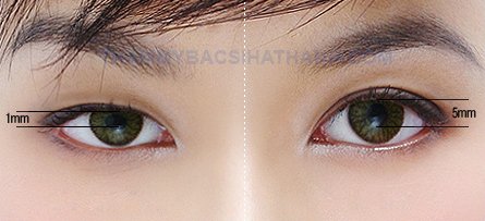 Khác biệt vượt trội của cắt mí Hàn Quốc Khác biệt vượt trội của cắt mí mắt Hàn Quốc