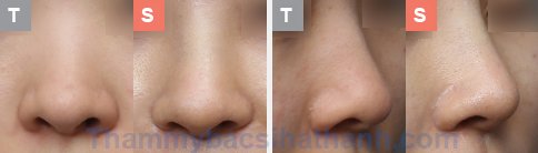 Kết quả sau khi thực hiện thu gọn cánh mũi Kết quả sau khi thực hiện thu gọn cánh mũi