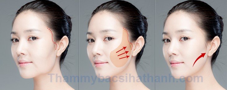 Căng da mặt bằng chỉ vàng giúp da mặt căng mịn