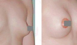 Sự khác biệt nâng ngực nội soi và sa trễ
