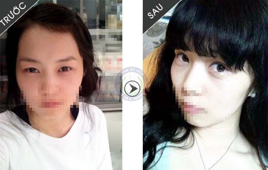 Trước và sau khi thực hiện cắt mí và lấy mỡ mí mắt