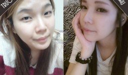 Hình ảnh trước và sau khi cắt mí mắt Hàn Quốc