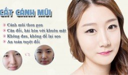 Cảm nhận của Trúc Mai về cắt cánh mũi