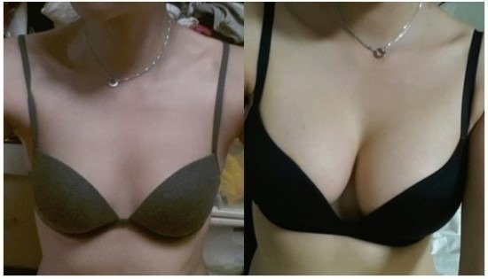 Kim Yến trước và sau khi nâng ngực nội soi Dual Face