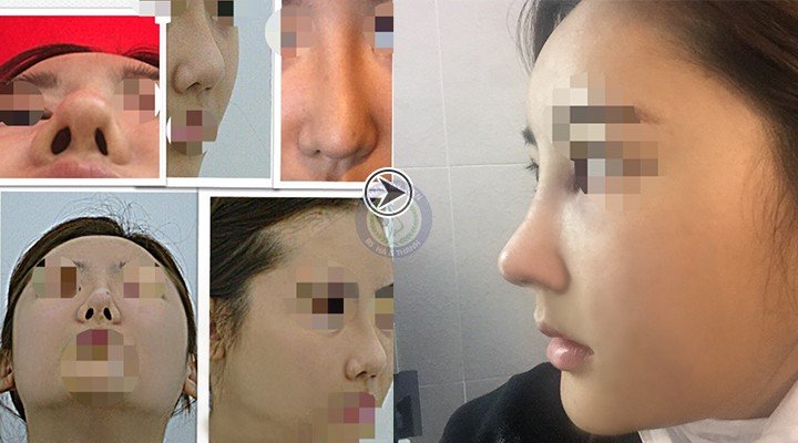 Trước và sau khi nâng mũi s line của Quỳnh Dung