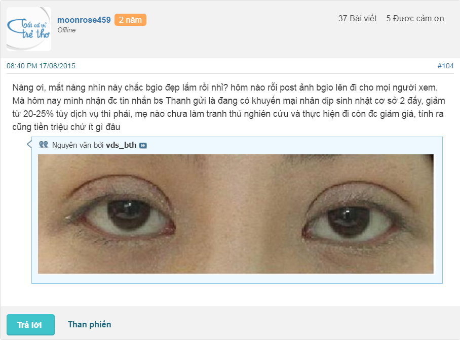 Hình ảnh thực tế của 1 chị em cắt mí mắt tại hà Thanh chia sẻ trên webtretho