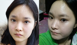 Hoài Thu trước và sau khi bấm mí mắt Hàn Quốc tại Hà Thanh