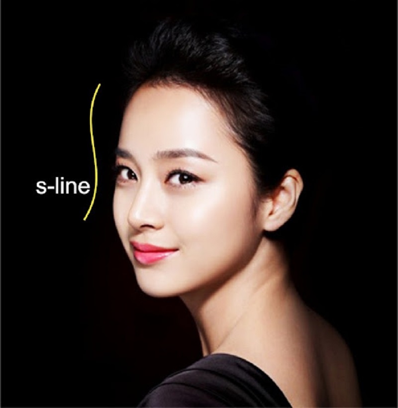 Hiệu quả thu gọn cánh mũi rõ rệt chỉ sau một lần thực hiện